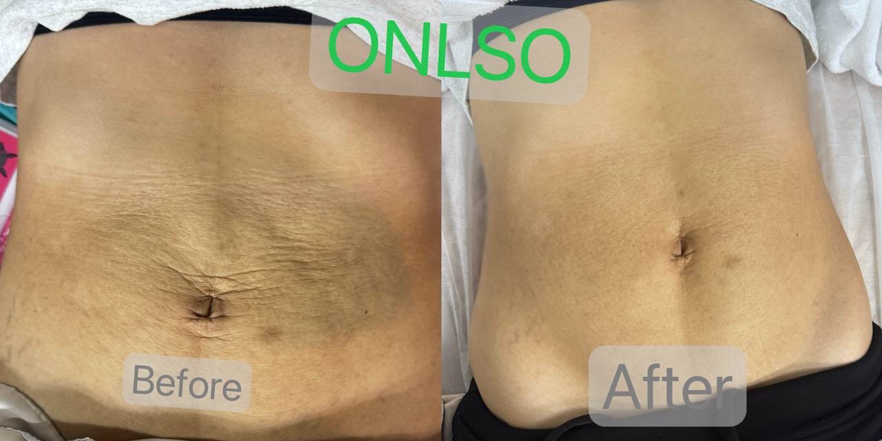 Postpartum abdominal photo comparison supplied by ONLSO