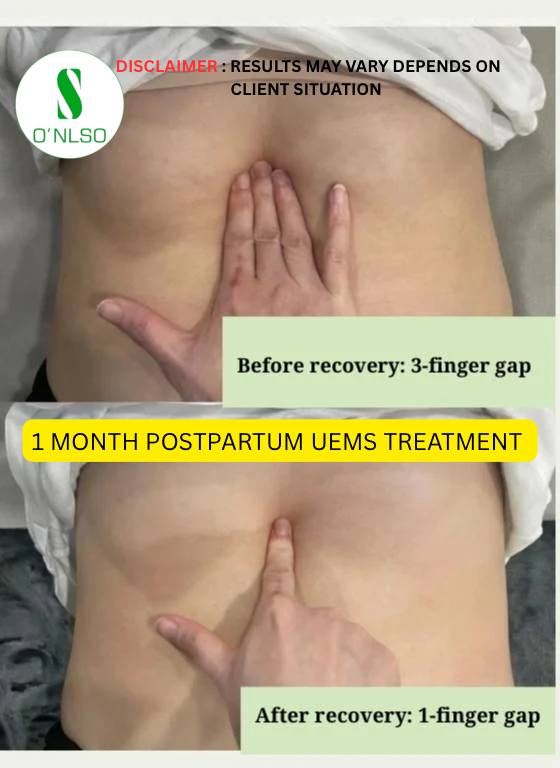 ONLSO uems postpartum one month comparison